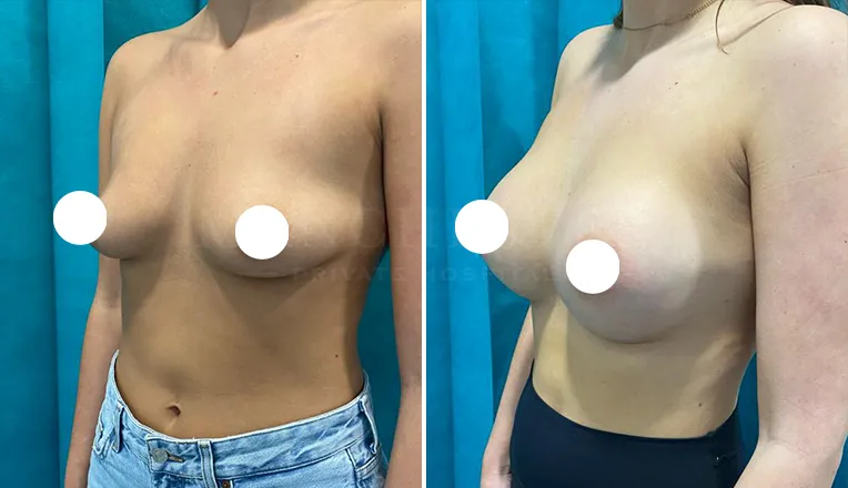 breast enlargement before and after patient-6-v5