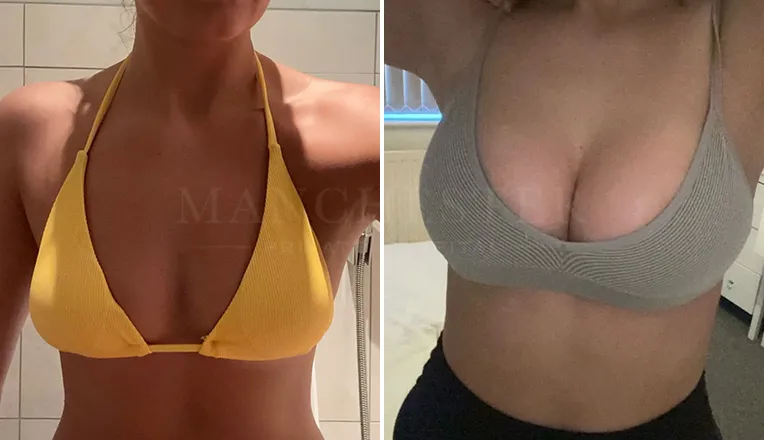 breast enlargement patient results-10