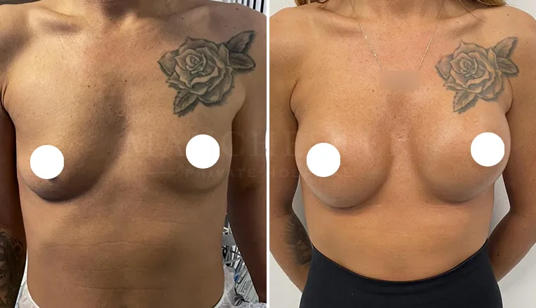 breast enlargement patient results-11