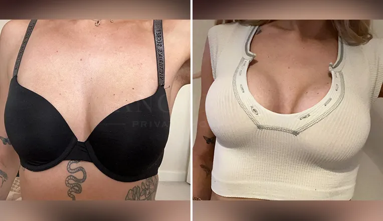 breast enlargement patient results-12