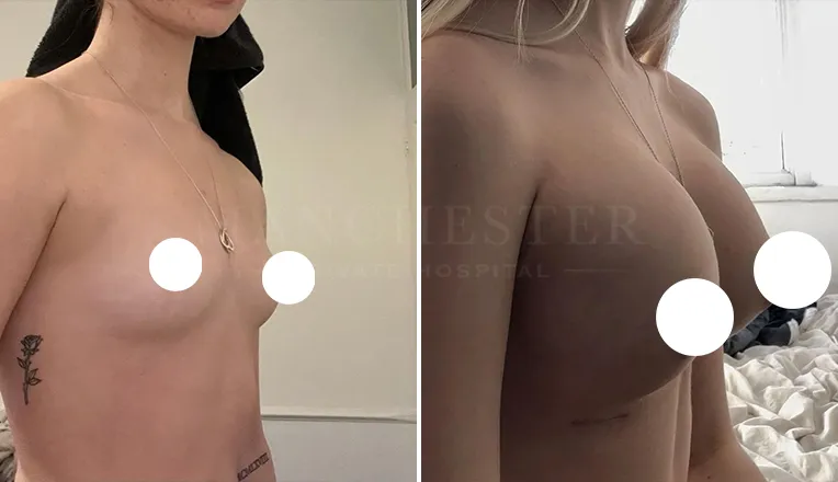 breast enlargement patient results-9-v2