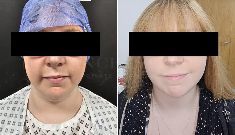 chin vaser liposuction results-2-v1