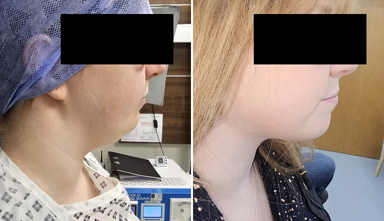 chin vaser liposuction results-2-v3