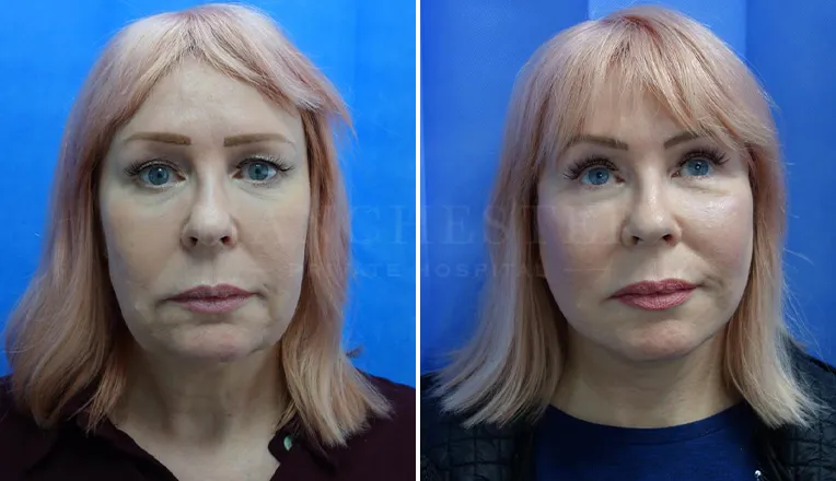 facelift before and after result-5