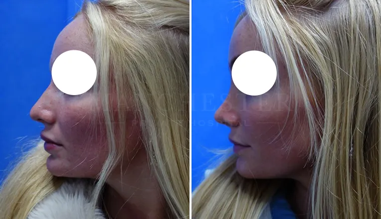 rhinoplasty before and after patient-5-v3