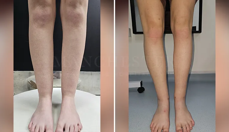 vaser lipo thighs before after patient-6-v1