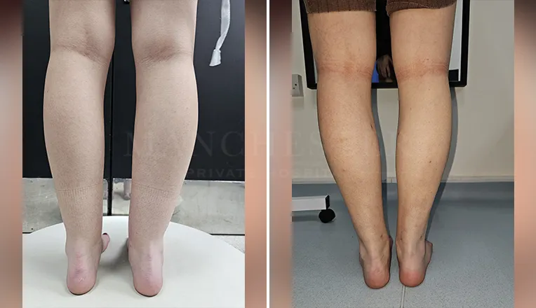 vaser lipo thighs before after patient-6-v2