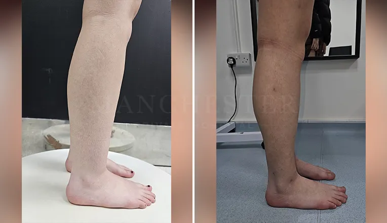 vaser lipo thighs before after patient-6-v3