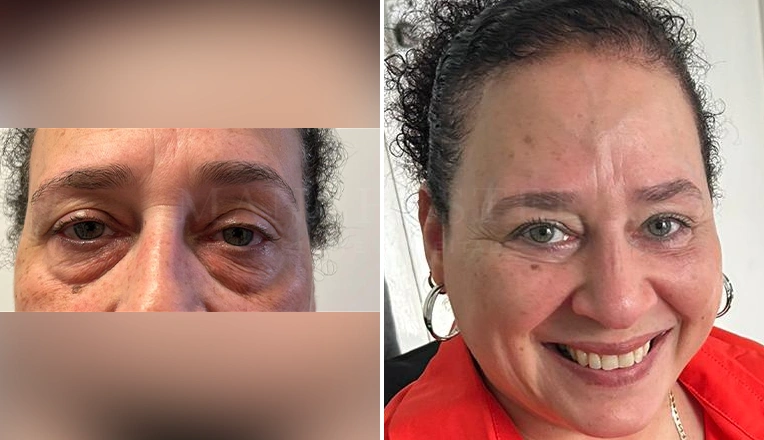 blepharoplasty before and after patient-6-v2