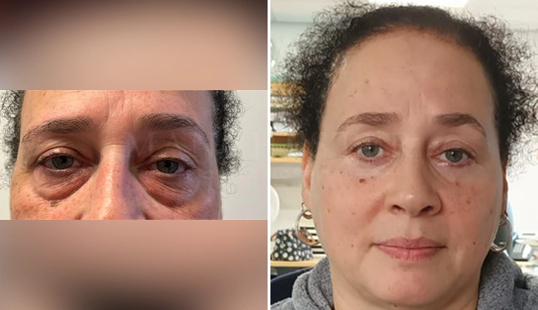 blepharoplasty before and after patient-6