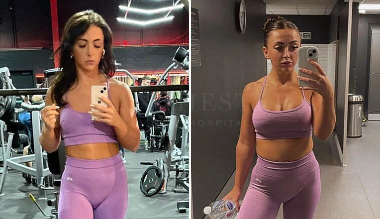 boob job before and after patient-6