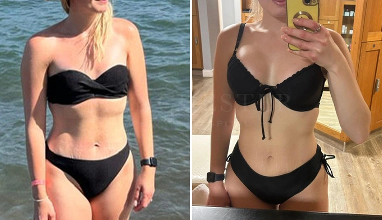 boob job before and after patient-7