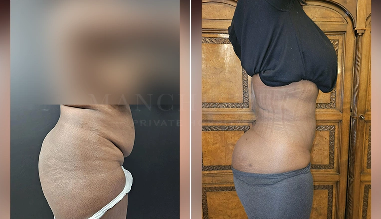 vaser lipo female abs before and after-4-v3