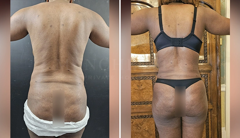 vaser lipo female abs before and after-5-v2