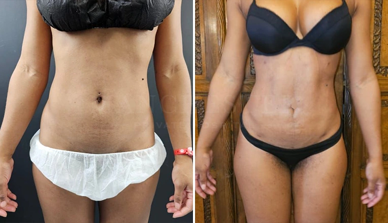 vaser lipo female abs before and after-6