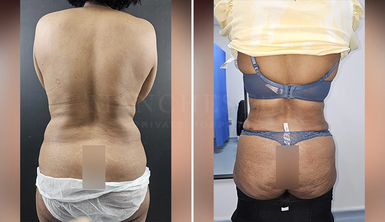 vaser lipo female abs before and after-9-v2