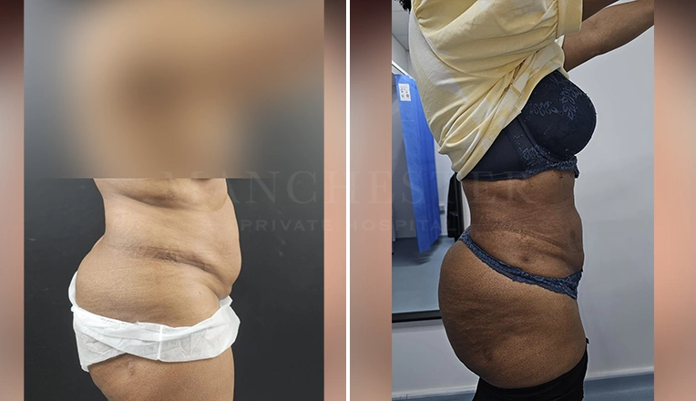 vaser lipo female abs before and after-9-v4