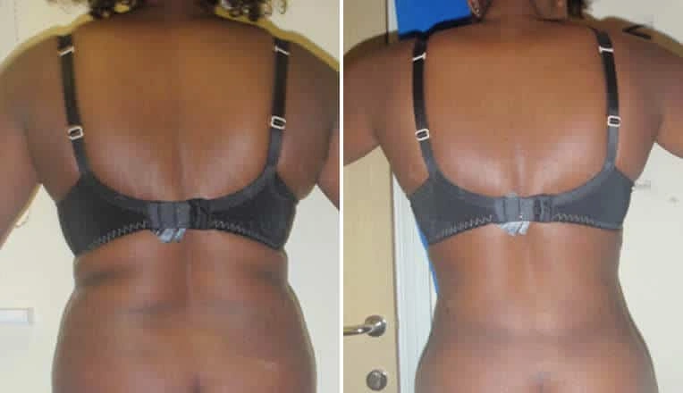 back-vaser-liposuction-before-and-after-2