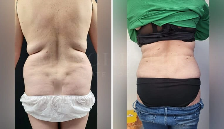 back-vaser-liposuction-before-and-after-4