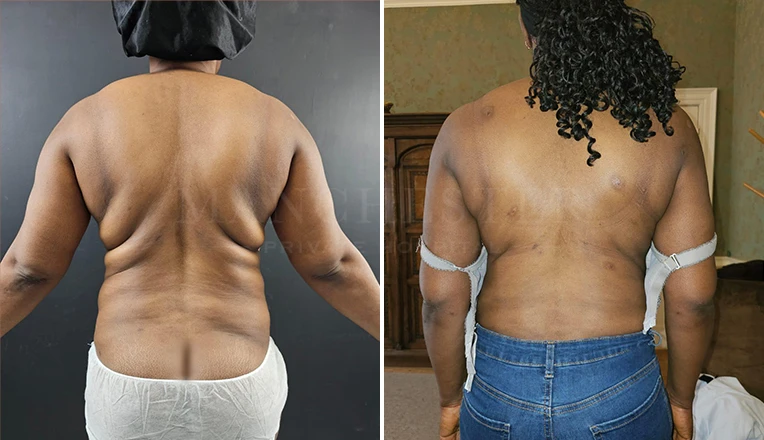 back vaser liposuction before and after-5