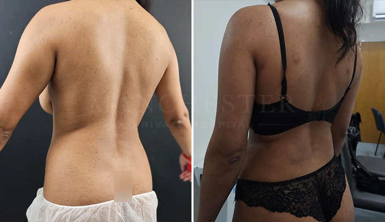 back vaser liposuction before and after-6-v2