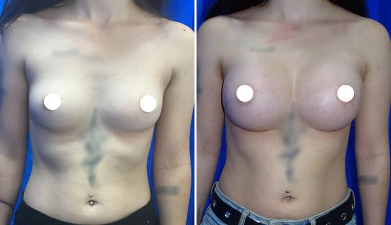 boob-job-before-and-after-4