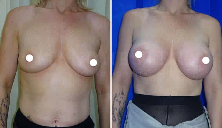boob-job-before-and-after-6