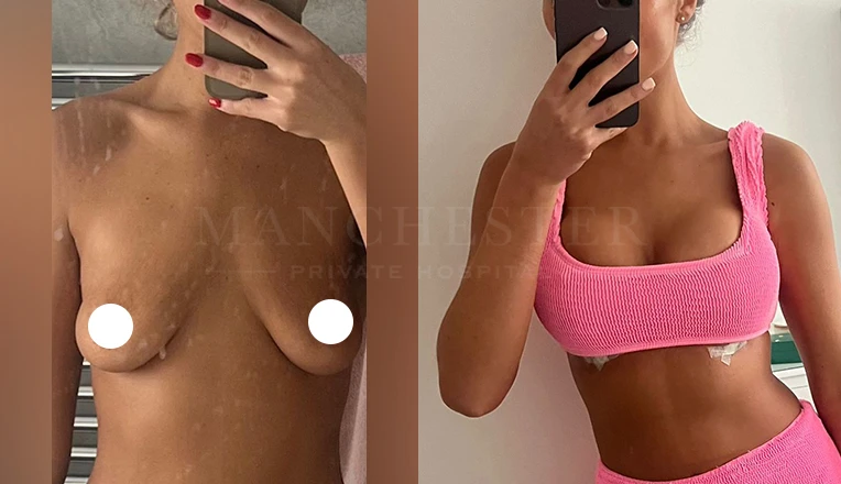 boob job before and after patient-5
