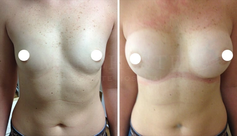 boob-job-before-and-after-uk-2