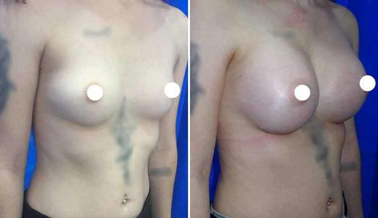 boob-job-before-and-after-uk-4