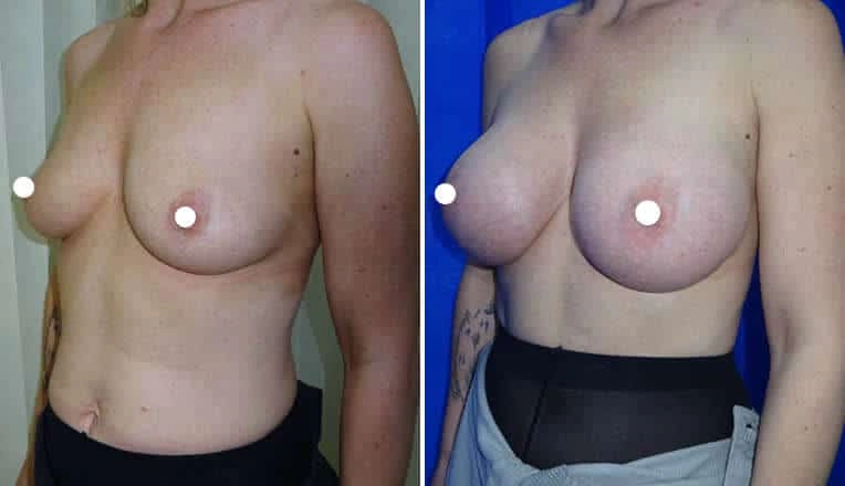 boob-job-before-and-after-uk-6
