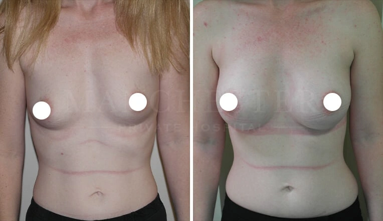 breast-augmentation-before-and-after-3