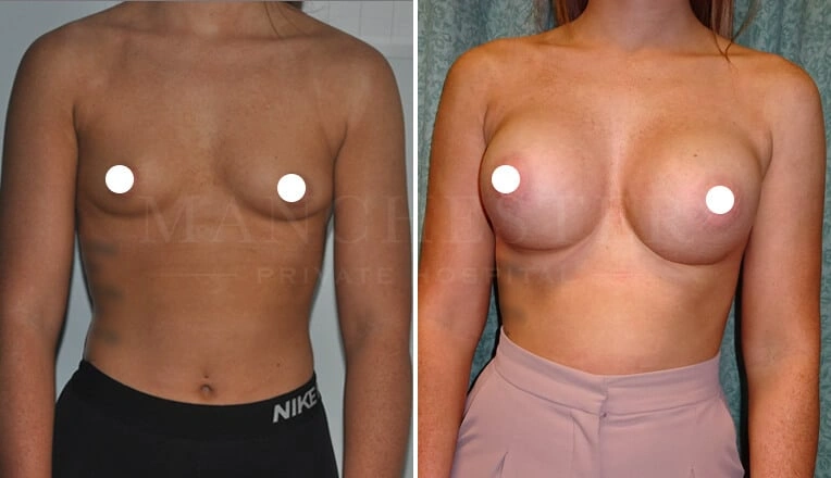 breast-augmentation-before-and-after-5