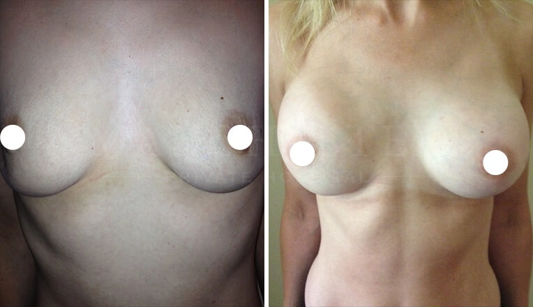 breast-augmentation-before-and-after-uk-3
