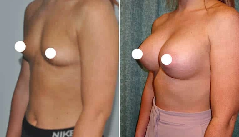 breast-augmentation-before-and-after-uk-5