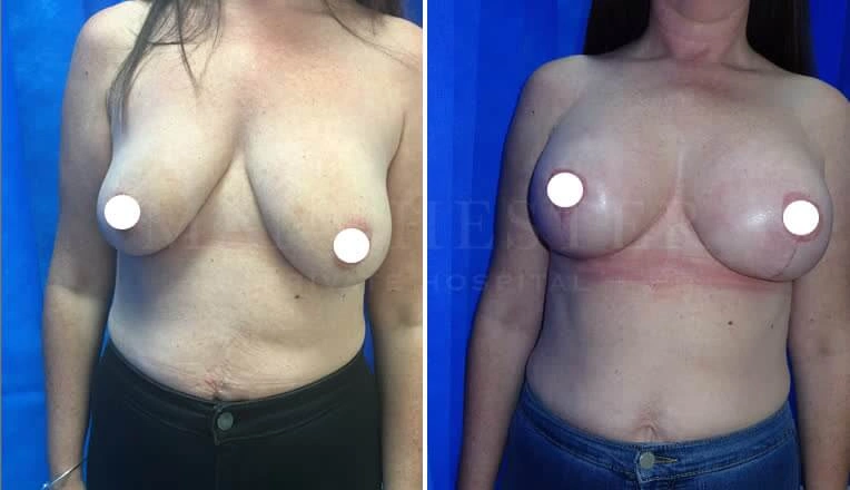 breast-enlargement-before-and-after-uk-7