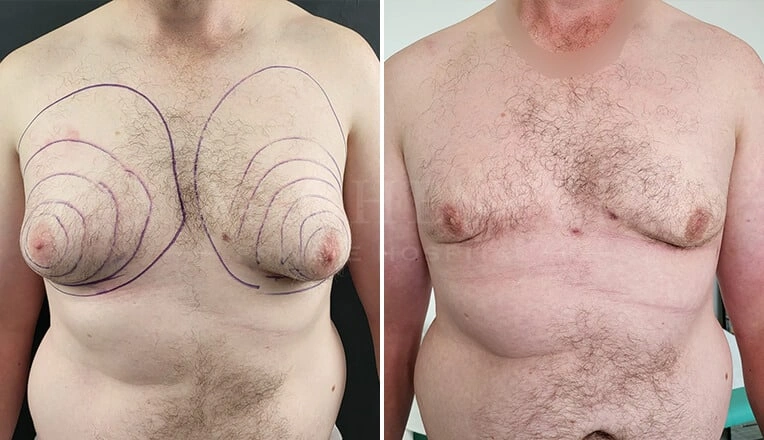 gynecomastia before and after by dr kam singh
