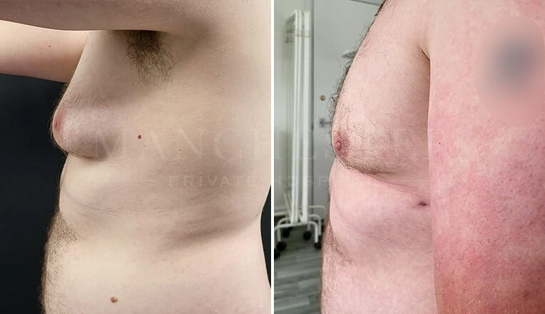 gynecomastia-before-and-after-by-dr-kam-singh-4