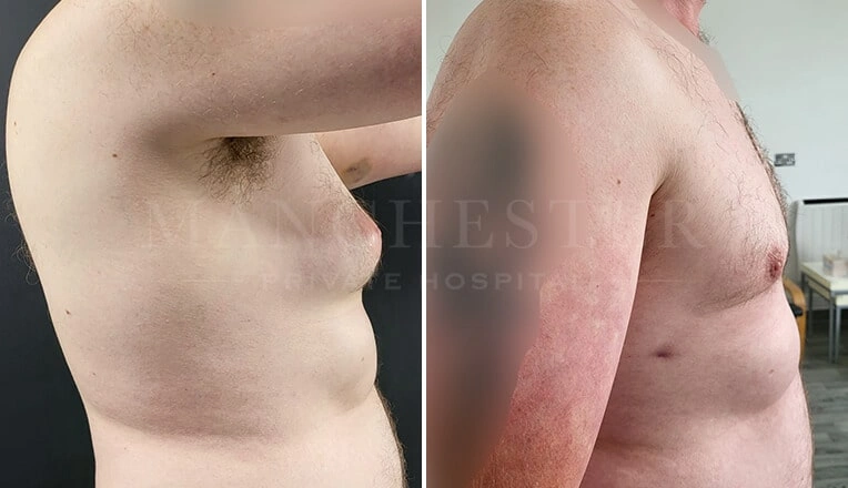 gynecomastia-before-and-after-by-dr-kam-singh-5