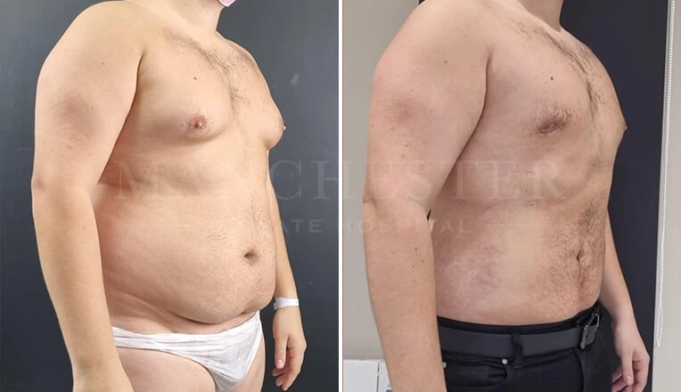gynecomastia-before-and-after-surgery-by-mr-fiore