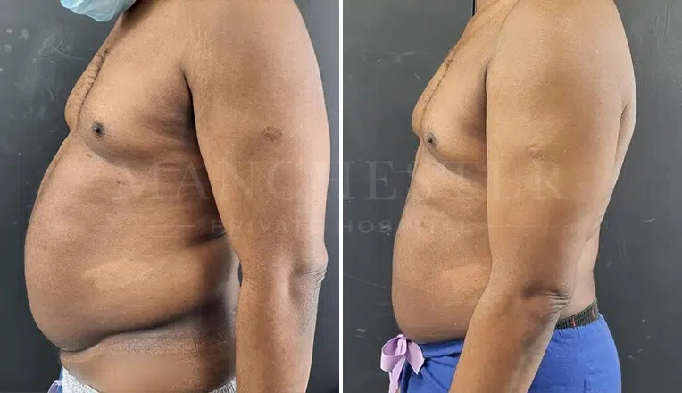 gynecomastia-before-and-after-surgery-by-mr-fiore