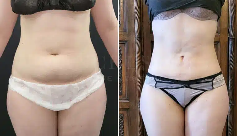 stomach-vaser-liposuction-before-and-after