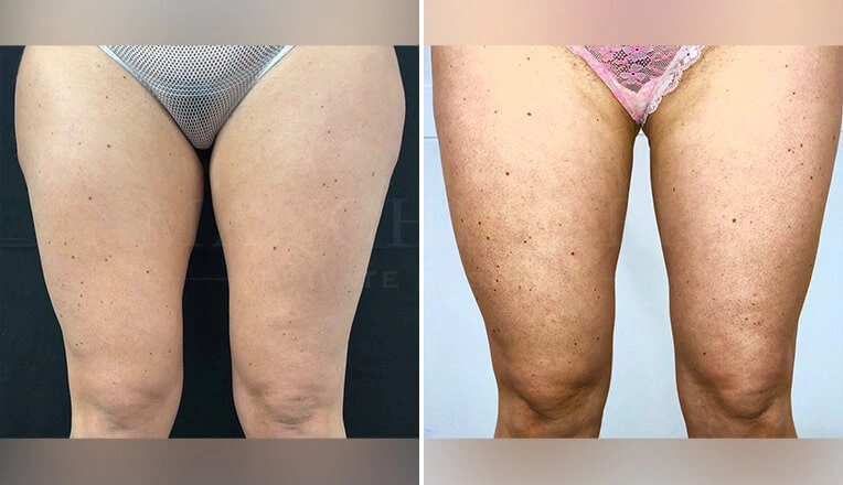 thigh-liposuction-before-and-after-uk