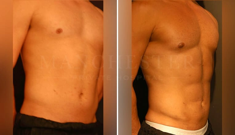 vaser-hi-def-lipo-before-and-after-1