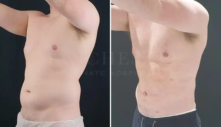 vaser-hi-def-lipo-before-and-after