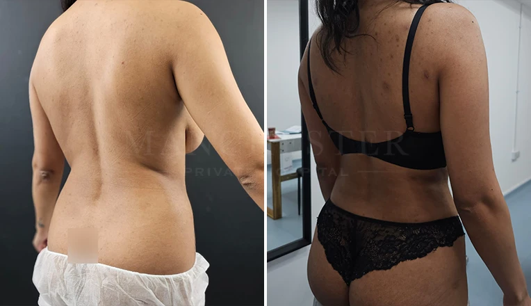 vaser lipo before and after by dr kam singh-5