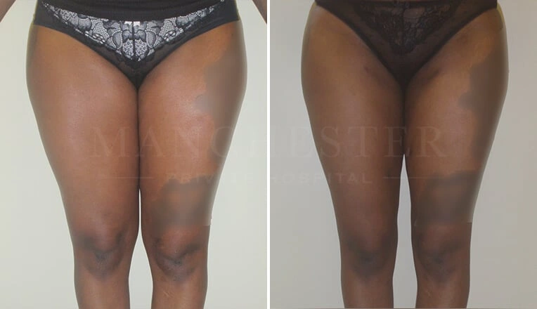 vaser-lipo-legs-before-and-after-1