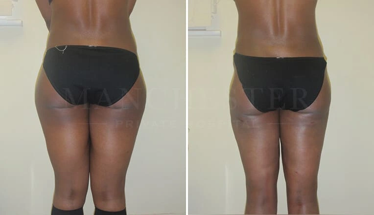 vaser-lipo-legs-before-and-after