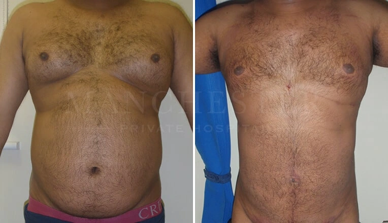 vaser-lipo-male-before-and-after-6