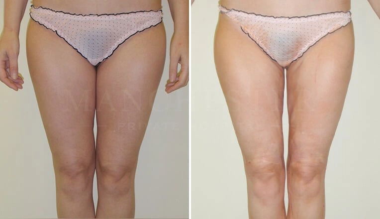 vaser-lipo-thighs-before-after-1